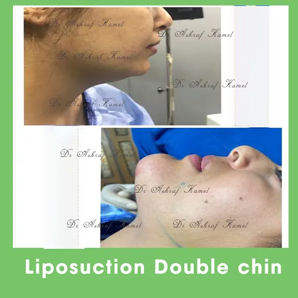 Liposuction Double Chin